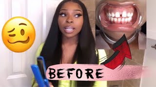 I GOT MY TEETH DONE FOR 2K! | 4 Month Smile Direct Club Update | Gap Teeth Transformation