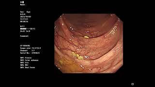 [Sample video]  Total colonoscopy : no cap OLYMPUS 290 + CF-H260AL