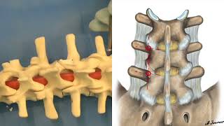 Principles / technique of thoracolumbar pedicle screw placement - video 15 min