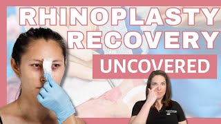 An Honest Look at Rhinoplasty Recovery - What to Really Expect