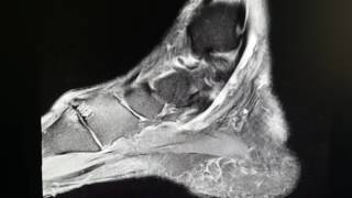 Flexor Hallucis Longus Tendon Rupture as seen on MRI