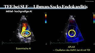 〖Echokardiografie〗 Libman Sacks Endokarditis 🫀