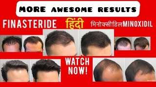 Most AWESOME RESULTS OF HAIR REGROWTH|FINASTERIDE|MINOXIDIL|results|TRANSPLANT|Line|Hair|Fall|patch|