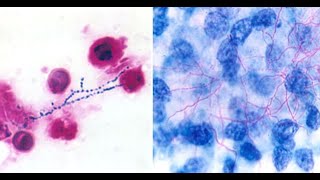 Nocardiosis, aspergillosis, and bacillary angiomatosis