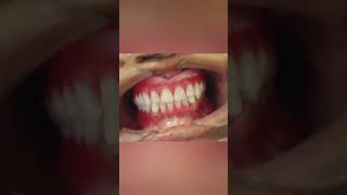 teeth replacement #dentist #completedenture #dr