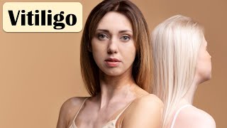 Vitiligo - Causes, Pathogenesis, Signs & Symptoms, And Treatment