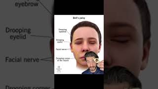 Bells Palsy Treatment Salt Lake City | Bells palsy Doctor Salt Lake City | Neckwise SLC