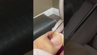 Deep Ingrown Nail Removal - Multiple Pieces Came Out! #shortsvideo #satisfying  #ingrownnailremoval