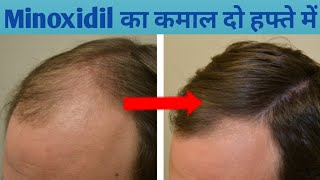 Minoxidil hair regrowth results | minoxidil for hair growth