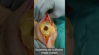 Squeeze Out Your Silicone Breast Implant Safely - Removal of Breast Implant - Squeezing Out Silicone