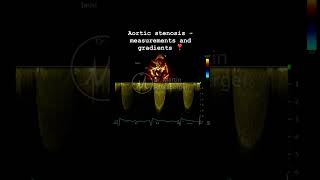 Severe aortic stenosis, AVA, PW, CW Doppler🫀