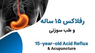 درمان رفلاکس مزمن 15 ساله --- Chronic Acid Reflux and Acupuncture