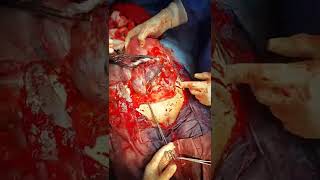 Total pelvic & broad lig percreta . Full length .. Conservative management l