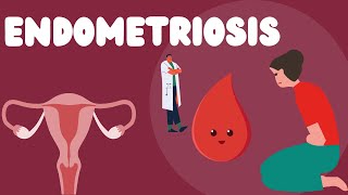 Understanding Endometriosis |Causes |Signs| symptoms |And Treatment |Simplified Chronic Pelvic Pain