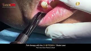 Pain therapy with the D-Storm Diode Laser