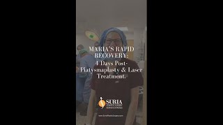 Maria’s Rapid Recovery: 4 Days Post-Platysmaplasty & Laser Treatment