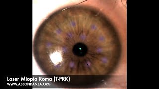 Laser Miopia Roma - Dr. Marco Abbondanza