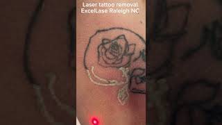 Laser removal of a not so scary skeleton tattoo #tattooremoval #lasertattooremoval #satisfying