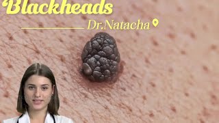 Dr.Natacha, blackheads, symptômes, causes,traitements, prévention.