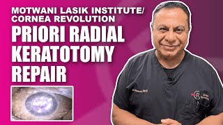 Radial Keratotomy (RK) Repair and Smoothening of the Cornea for Recorrection