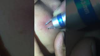 980nm laser vascular removal