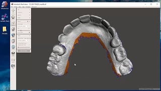 Advanced Techniques with Dental CAD - Working with Difficult Models and Getting Ready for Printing