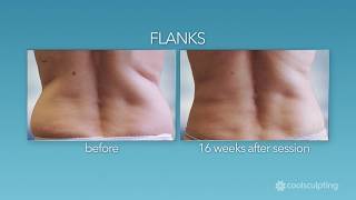 CoolSculpting: How Long Does Each Treatment Take?