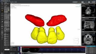 Trapped Canines Segmentation inducing Root Resorption