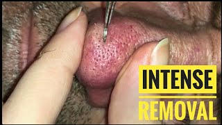 68 years old nose blackheads extraction + aftercare