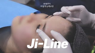 비절개 눈매교정 Ji-Line [MH클리닉]