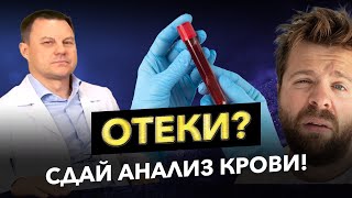 ОТЕКИ: срочно сдай анализ крови! Интервью с гематологом