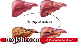 وای از وقتی که کبد چرب درمان نشه!!!