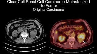 Renal Cell Carcinoma Case 24: Clear-Cell Renal Cell Carcinoma Metastasis