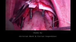 How to set fixed third teeth in a day? - With the Camlog Comfour concept!