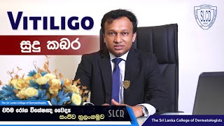 Vitiligo (සුදු කබර) - Dr. Sanjeewa Hulangamuwa, Consultant Dermatologist #skincare #dermatology