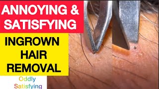 Oddly Satisfying Ingrown Hair Extraction | Ingrown Hair Removal