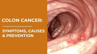 Colon Cancer : Symptoms, Causes & Prevention | Colorectal Cancer | Healthie Genie