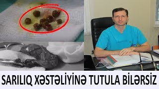 DİQQƏT! Ödünüzdə daş varsa - MÜTLƏQ BAXIN