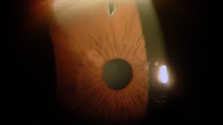 Iridotomia Laser per Glaucoma - Studi Oculistici Abbondanza