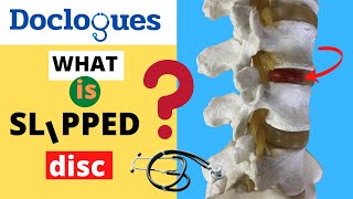 What is a slipped disc? Listen to Neurosurgeon!