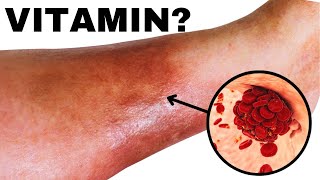 The #1 Worst Vitamin deficiency Behind this ..... It's Not What You Think!