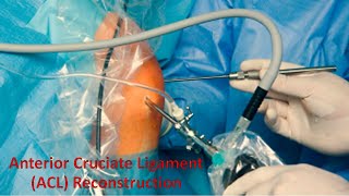 Anterior Cruciate Ligament (ACL) Reconstruction Knee Surgery by Dr Anil Lokhande, Orthopedic Surgeon