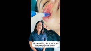 MICRONEEDLING For Acne Scars කුරුලෑ කැලැල් සදහා ප්‍රතිකාර Britanna Skin Clinic