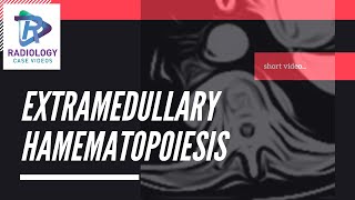 Extramedullary haematopoiesis   #Umamaheshwar Reddy. V