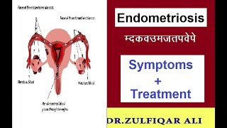 Endometriosis | अंतर्गर्भाशयकला | Symptoms | Treatment | Explained in Urdu/Hindi