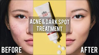 Acne & Dark Spot Treatments that actually work.