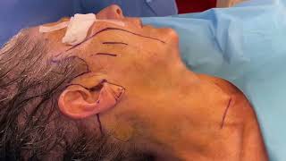 Lower Face & Neck Lift in South Florida performed under local anesthesia by Dr. Shashi Kusuma