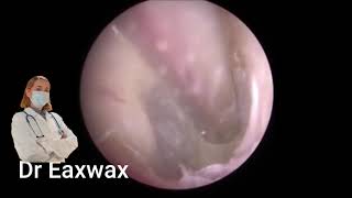 E-SUCTION OF INFECTION AND DEAD SKIN FROM EAR !