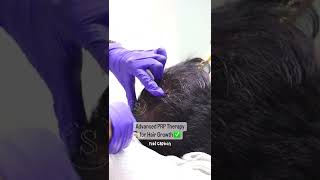 🔴 Condition: Male Pattern Hair Loss | Soul Skin Clinic - Anna Nagar