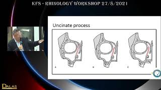 Endoscopic anatomy of the nose